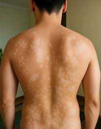 Tinea Treatment Specialist